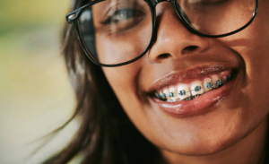 monthly braces cost
