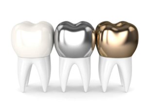 porcelain crowns vs metal crowns