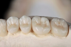 How Much Do CEREC Crowns Cost Compared to Traditional Crowns?
