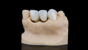 Why CEREC Crowns Might Cost More and Is It Worth It?
