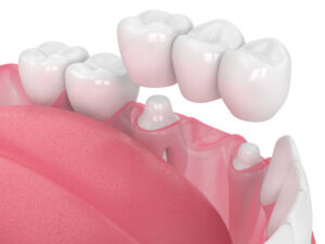 How Implant Bridges Can Be a Solution for Missing Teeth! 