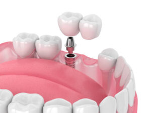 How Implant Bridges Can Be a Solution for Missing Teeth! 