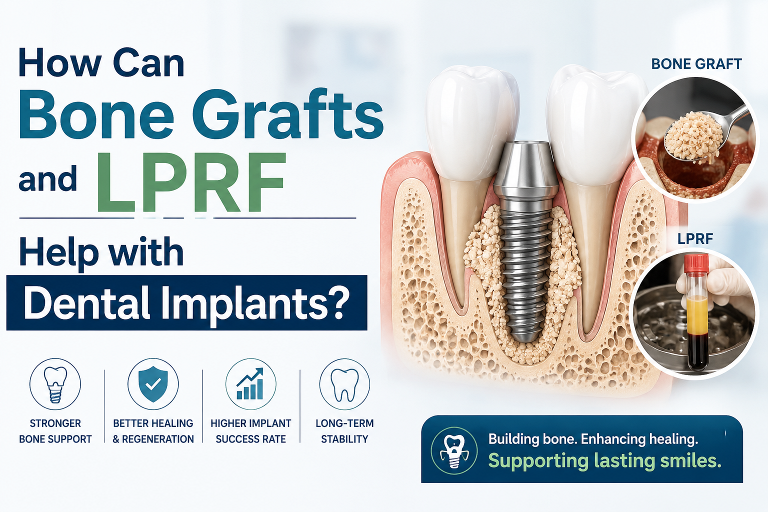 How Can Bone Grafts and LPRF Help with Dental Implants?
