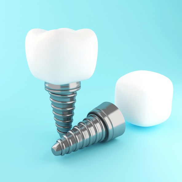 Dental Implants Overview