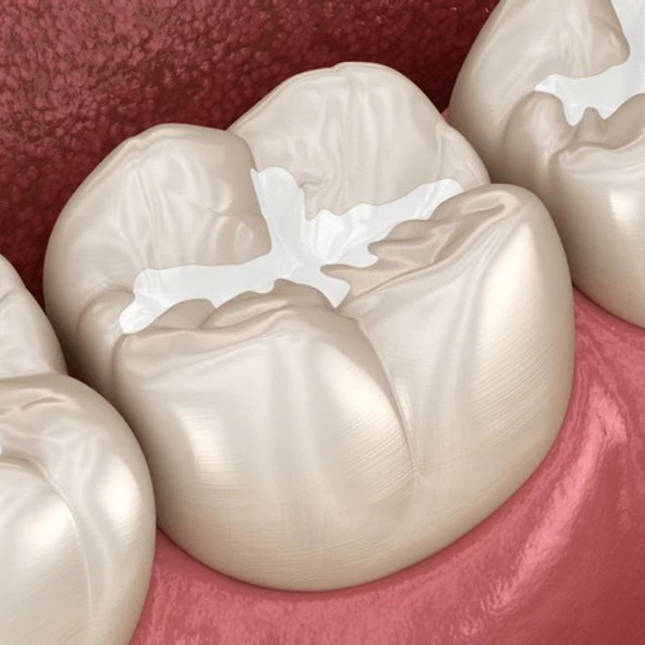 Are Dental Sealants Right For You?