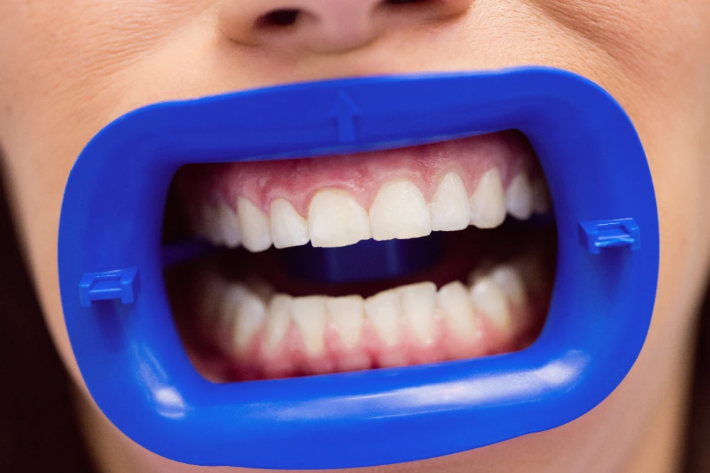 how to whiten stained fillings